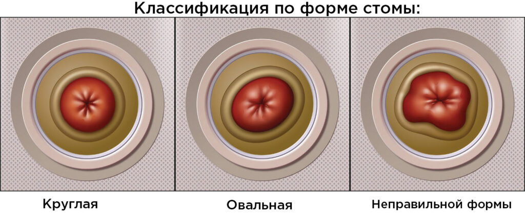 Классификация по форме стомы