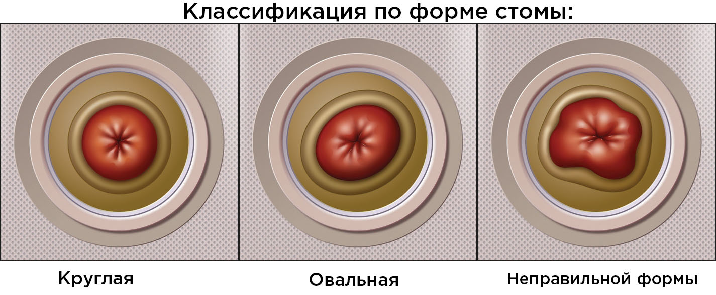 Как выглядит стома кишечника и фото